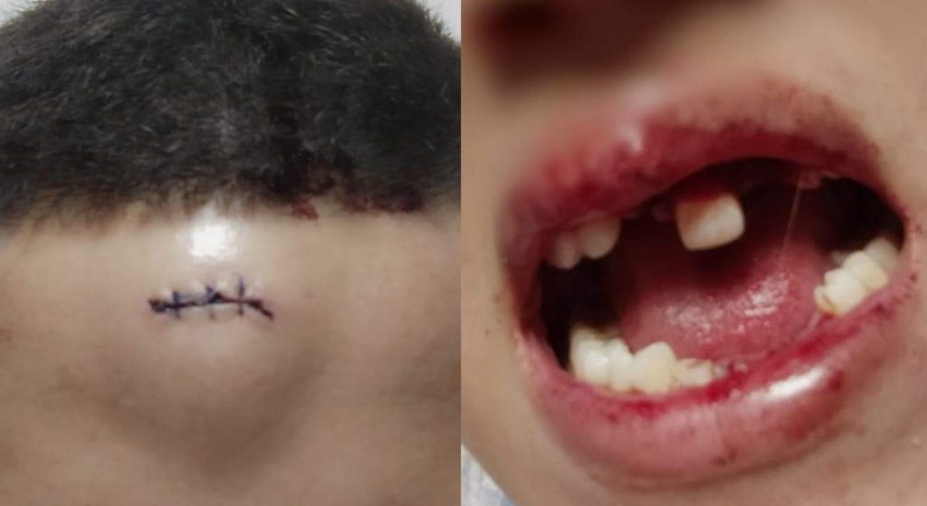El menor perdió parte de su dentadura y tendrá que someterse a un costoso tratamiento. Fotos para Q'hubo.